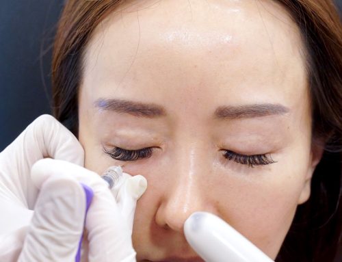 Why Tear Trough Fillers Can Make True Eye Bags Worse