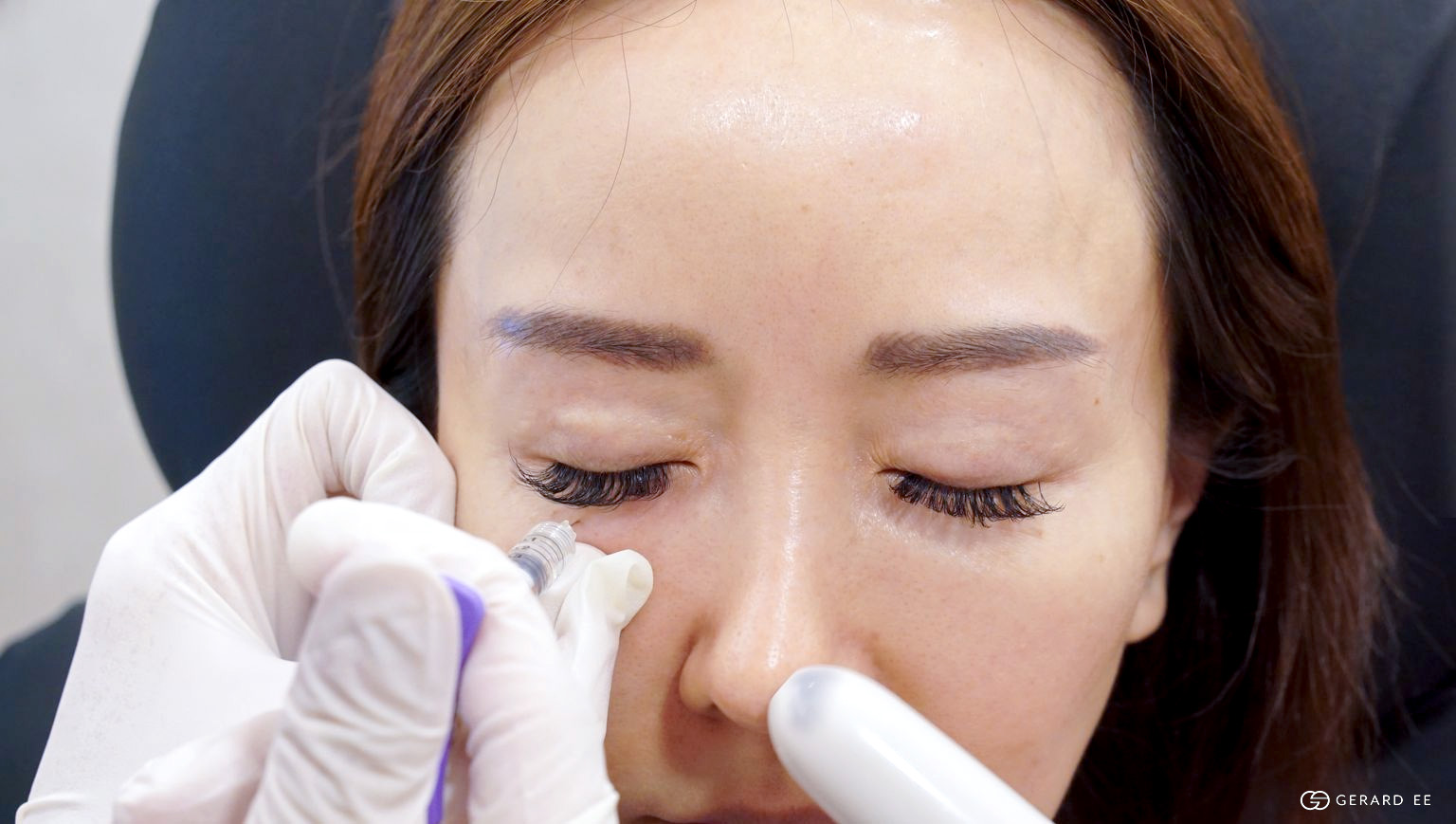 tear trough filler tear trough filler