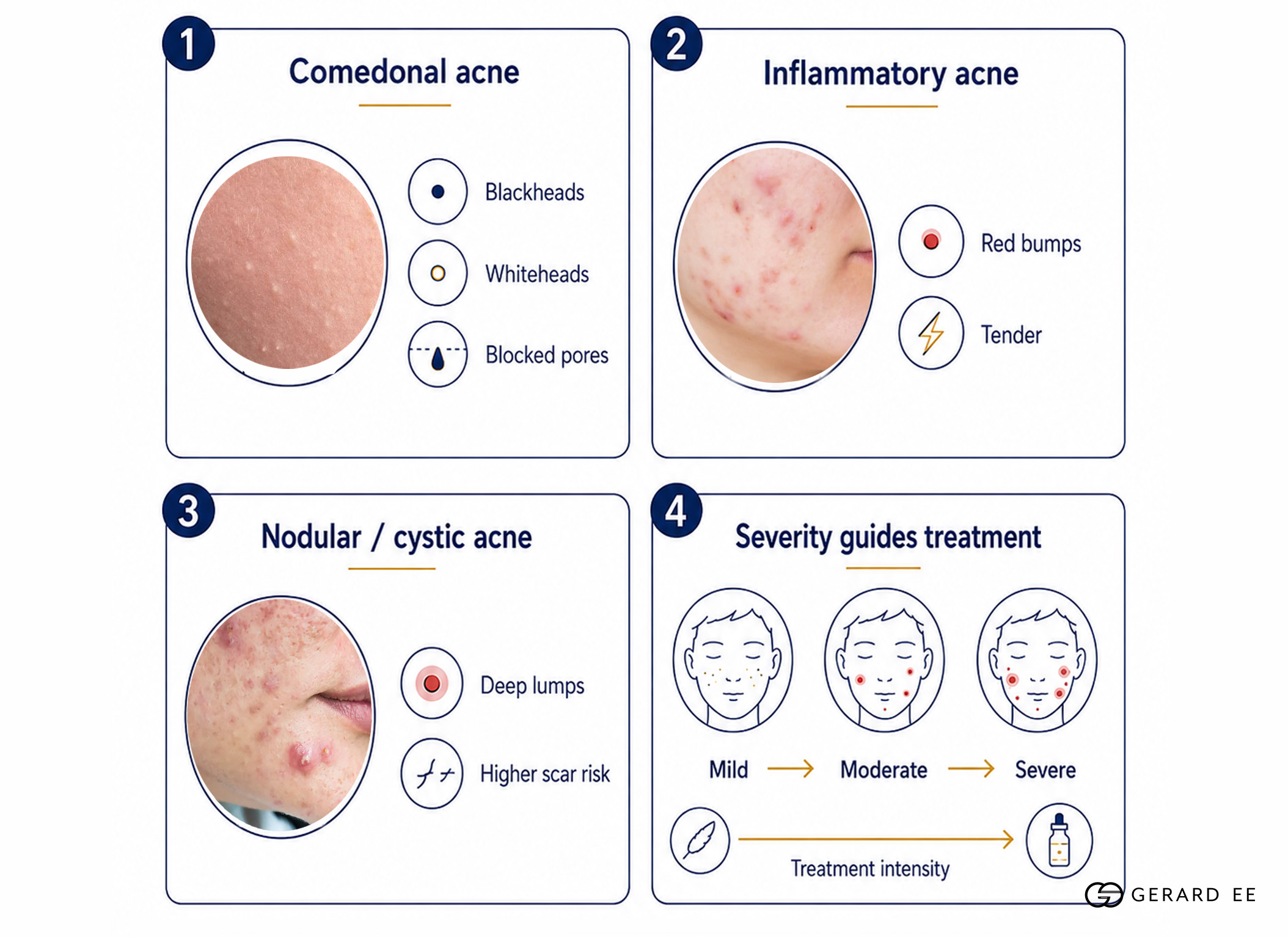 types of acne dge types of acne dge