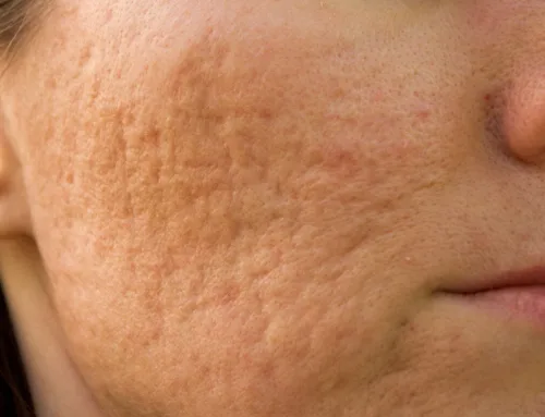Do Acne Scars Fade on Their Own?