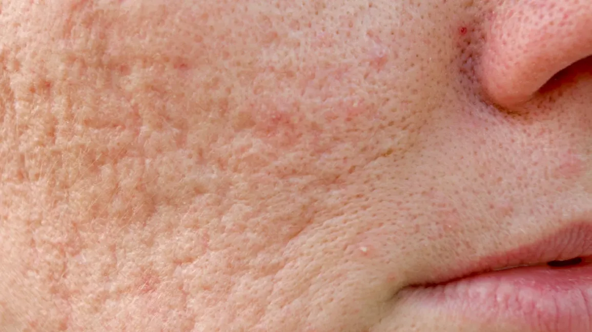 acne scar Rolling acne scar 1296x728 slide3 1