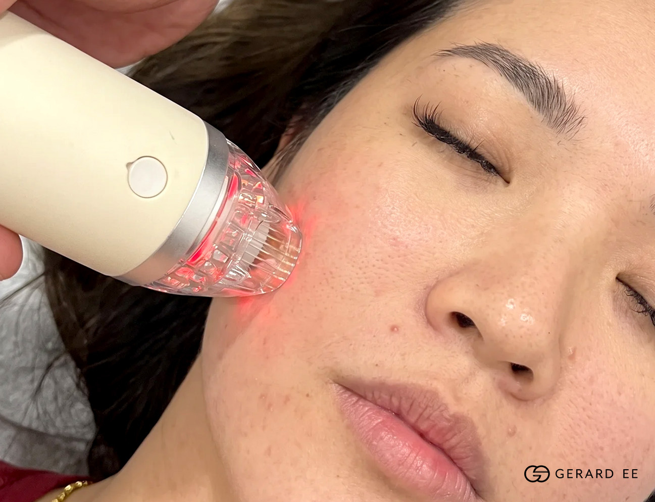 Secret RF treatment dge Secret RF treatment dge