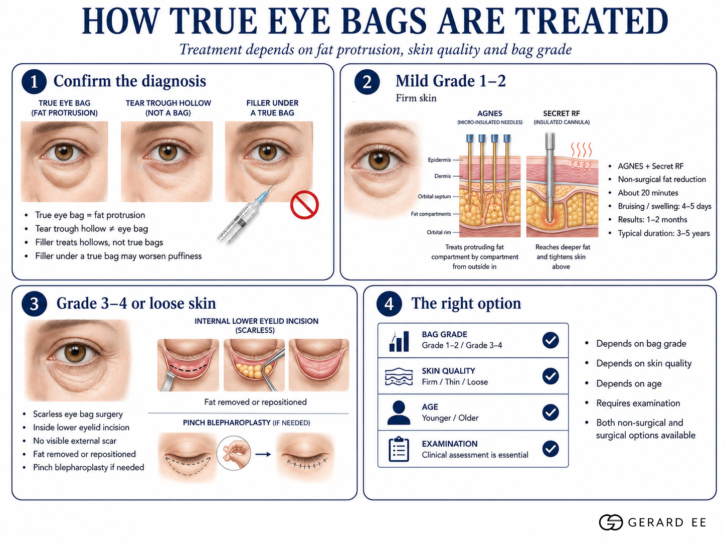 What actually removes true eye bags dge What actually removes true eye bags dge