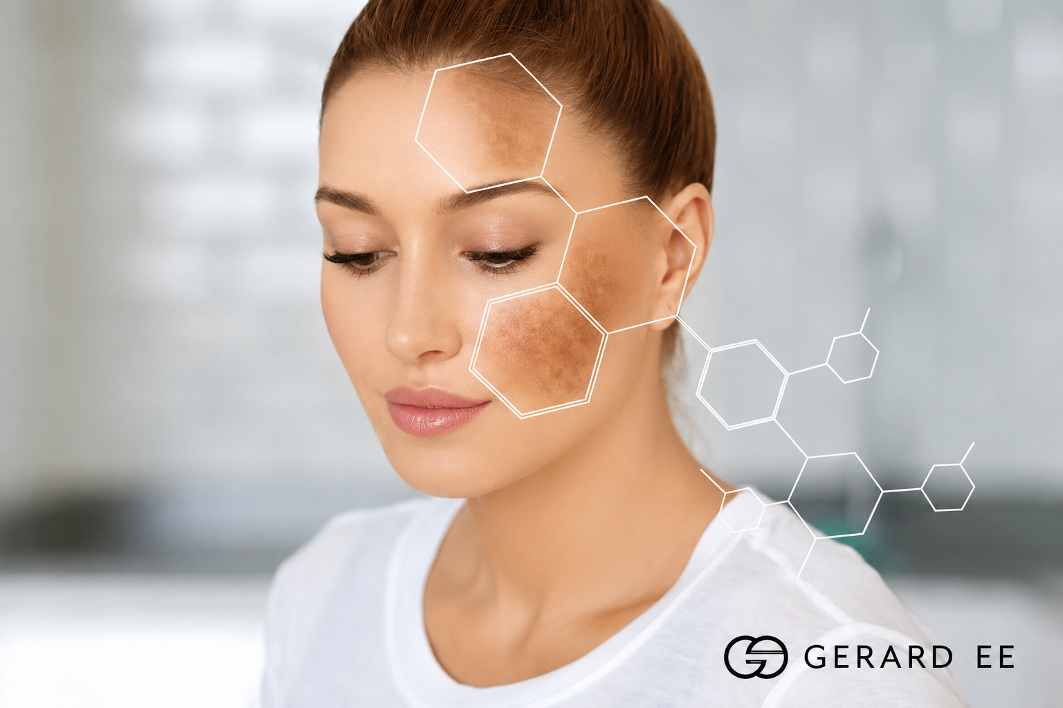 chemical peel for pigmentation