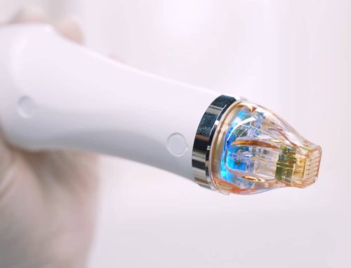 RF Microneedling for Acne Scars: Infini vs Secret RF