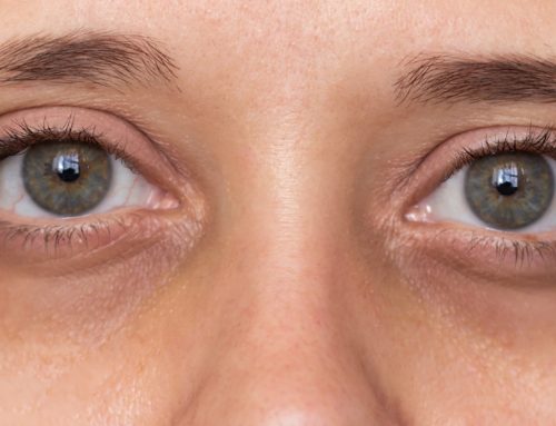 Dark Eye Circles from Allergies. Why Treating the Rhinitis Matters More Than Any Laser