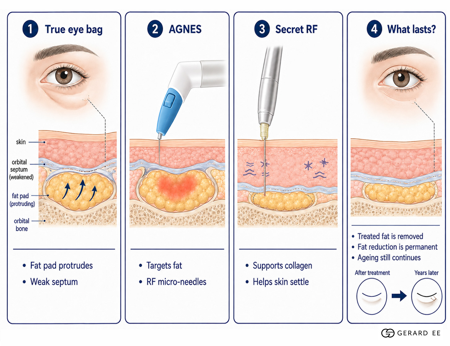 eyebag treatments
