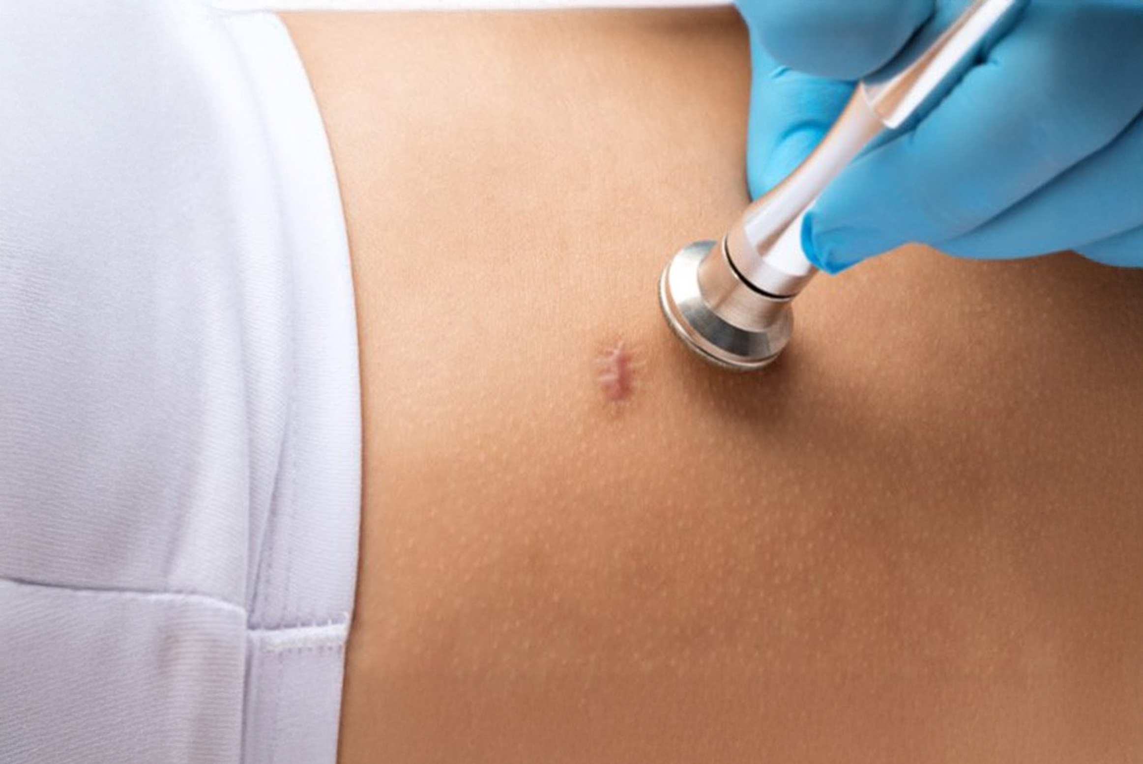 keloid examination keloid examination