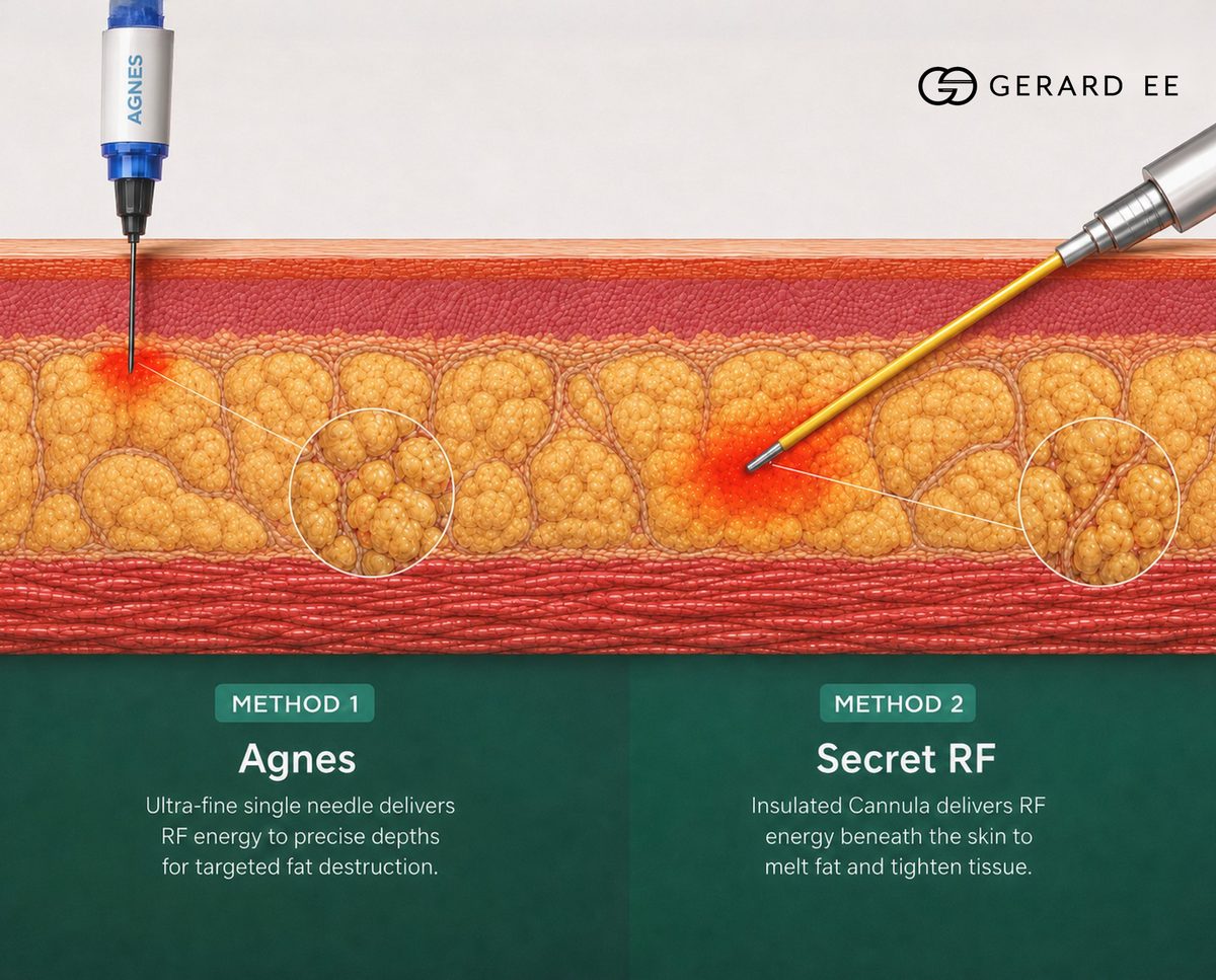 How non-surgical eye bag removal treats both the herniated fat pad and the lax skin above it