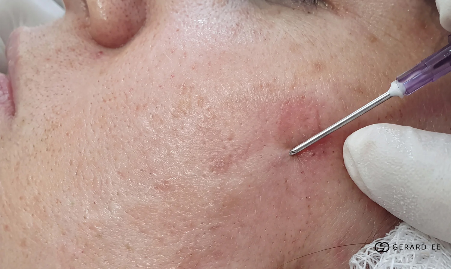 subcision treatment d ge