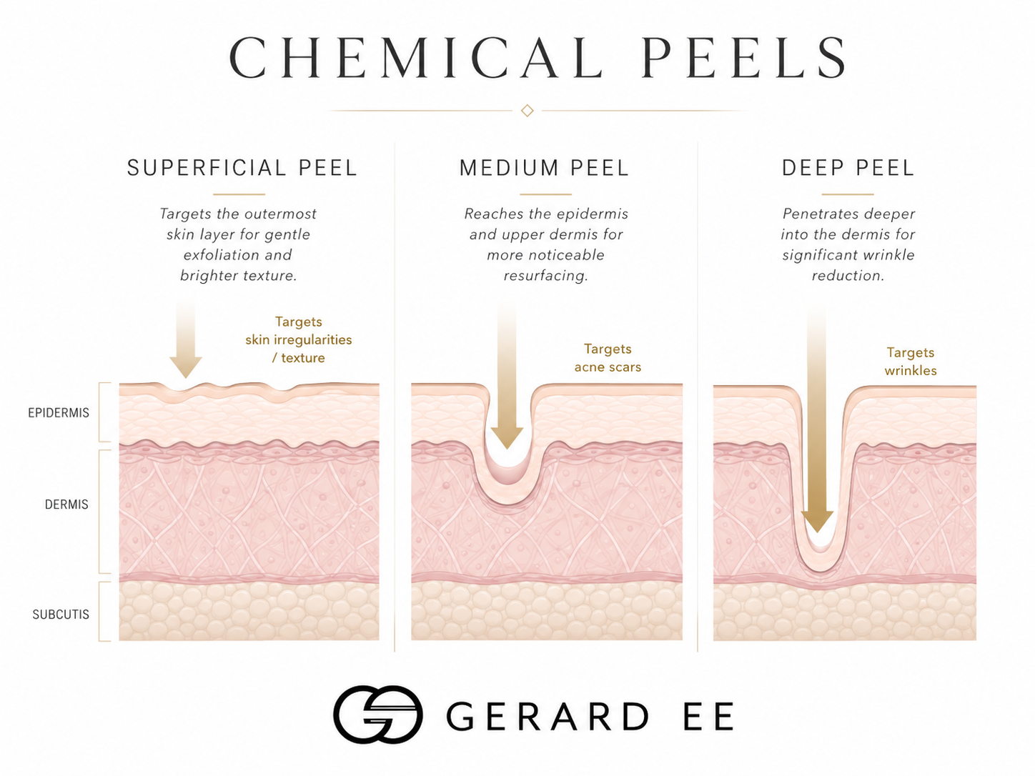 types of chemical peels in singapore