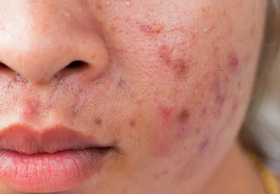 Inflamed acne on the cheek treated with light-based acne therapies