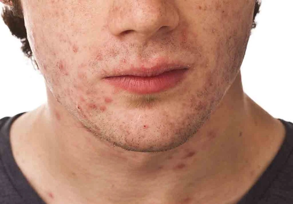 Adult male acne, discussed in relation to prostate cancer risk
