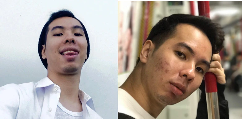 Patient acne before treatment, from the Mothership acne treatment review