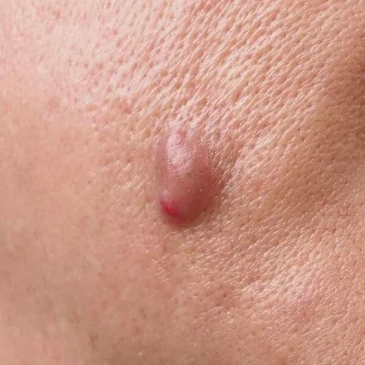 Cystic lesions: Nodules