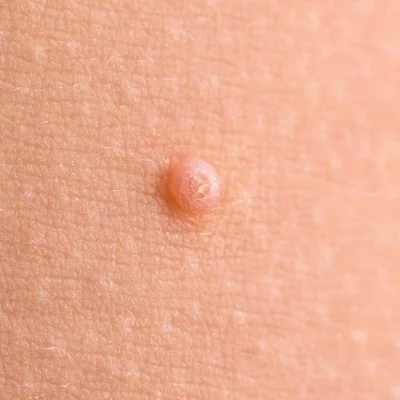 Nodule: Pustules