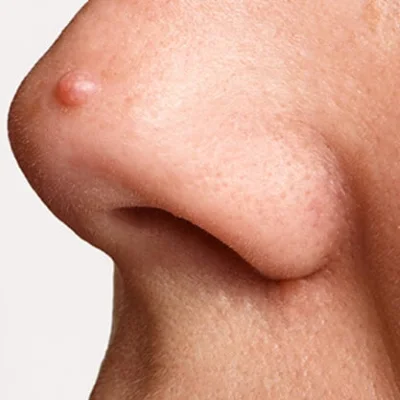 Papule: Types of Acne I Treat
