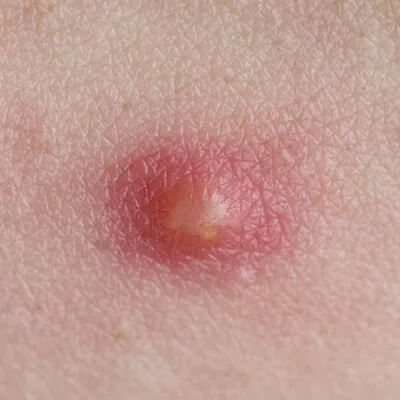 Pustule: Papules