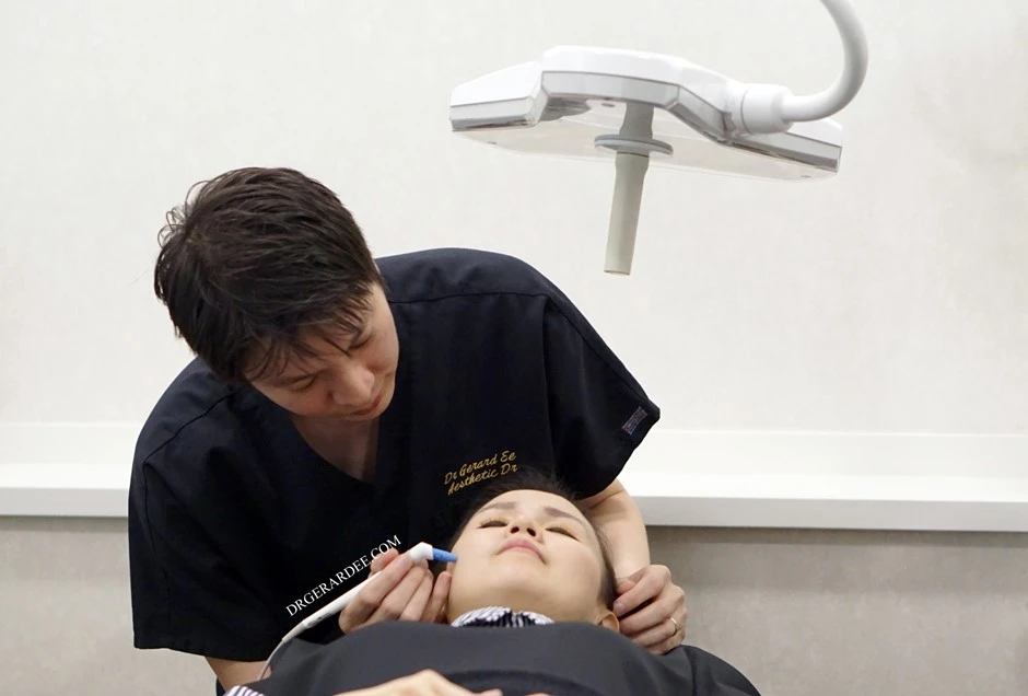 AGNES RF insulated microneedle treating an acne lesion