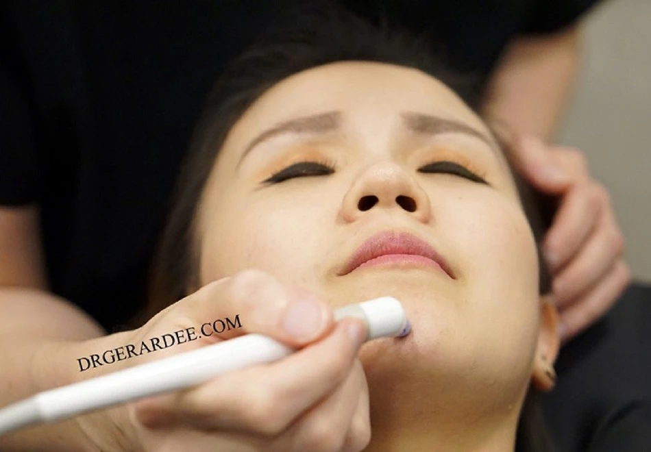 Dr Gerard Ee performing AGNES RF acne treatment in Singapore