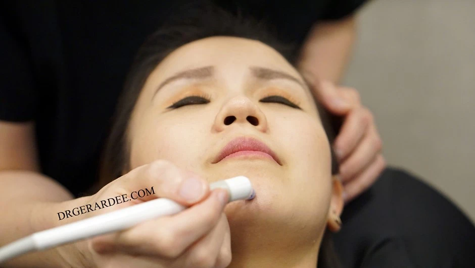 AGNES RF acne treatment on active acne on the cheek