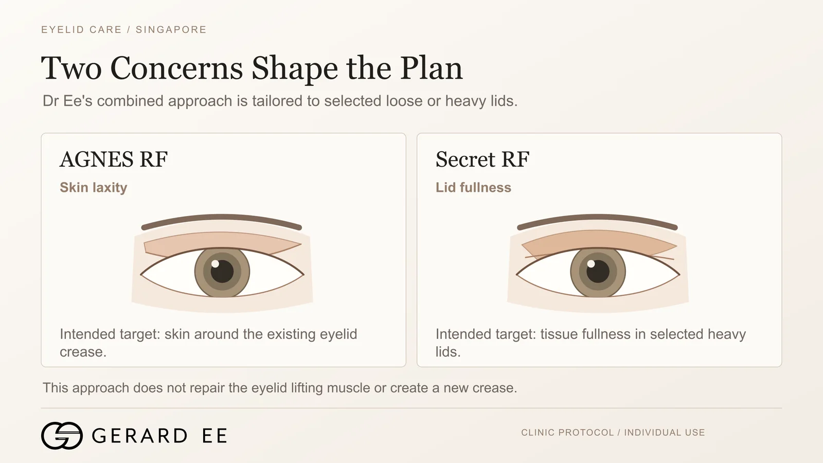 AGNES RF treats eyelid skin laxity and Secret RF treats upper lid fullness in the eyelid lift