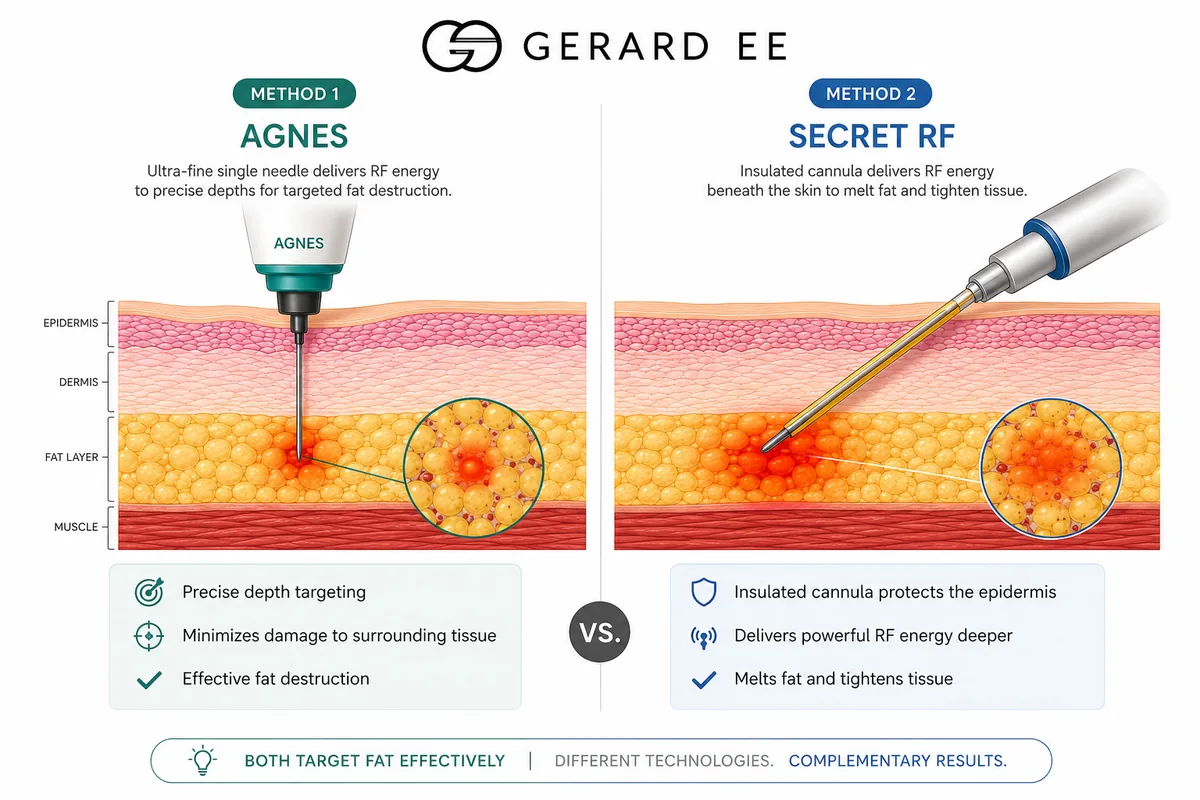 agnes secret rf non surgical alternative to eye bag surgery AGNES and Secret RF, the non-surgical alternative to eye bag surgery for mild bags