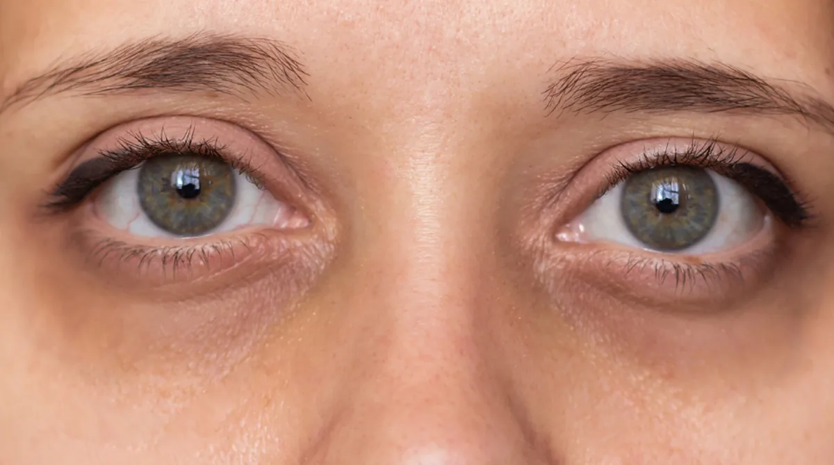 Allergic dark eye circles with shadowing and fine lines beneath both eyes