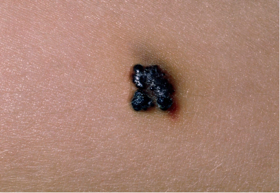 Benign angiokeratoma lesion on the skin
