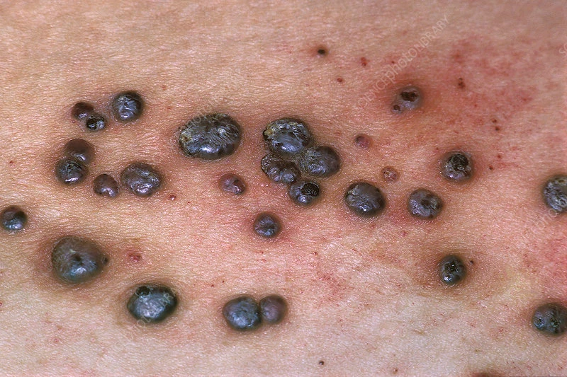 Angiokeratomas of Fordyce on the skin