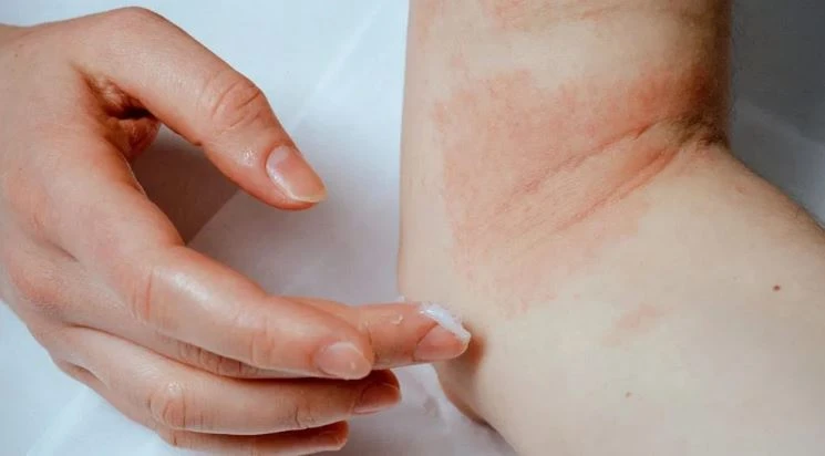 Eczema-affected skin in a patient with atopic dermatitis in Singapore