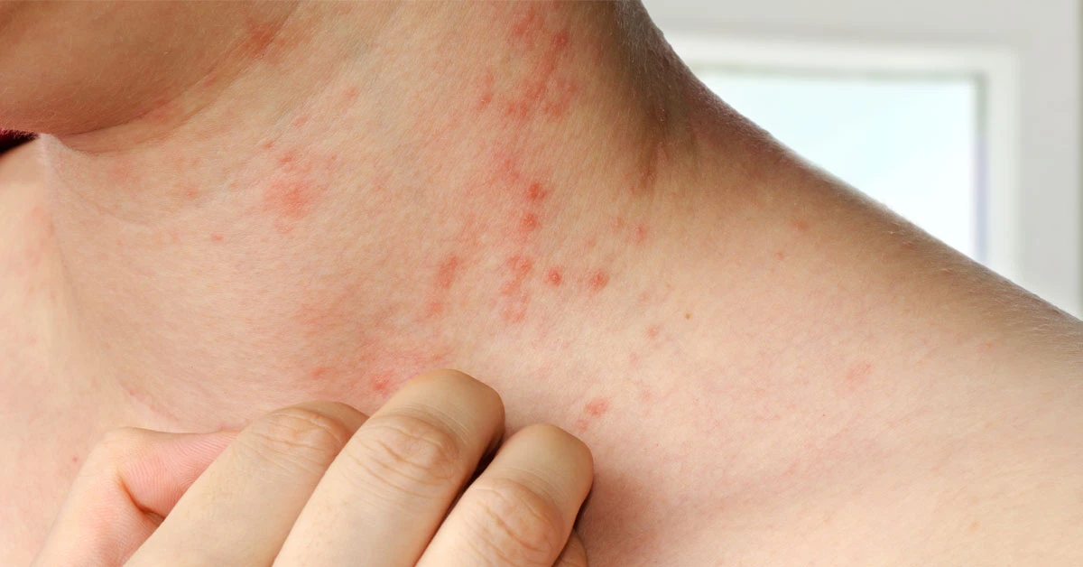 Atopic dermatitis flare treated in Singapore