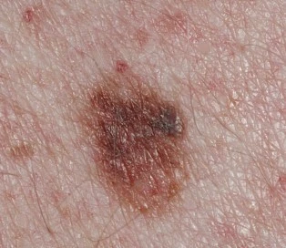 Atypical mole with an irregular border and uneven colour: atypical moles vs melanoma