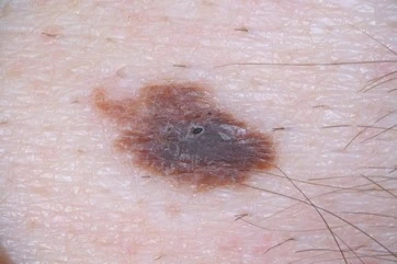 Atypical mole with uneven colour and blurred edge: when a weird-looking mole should be removed