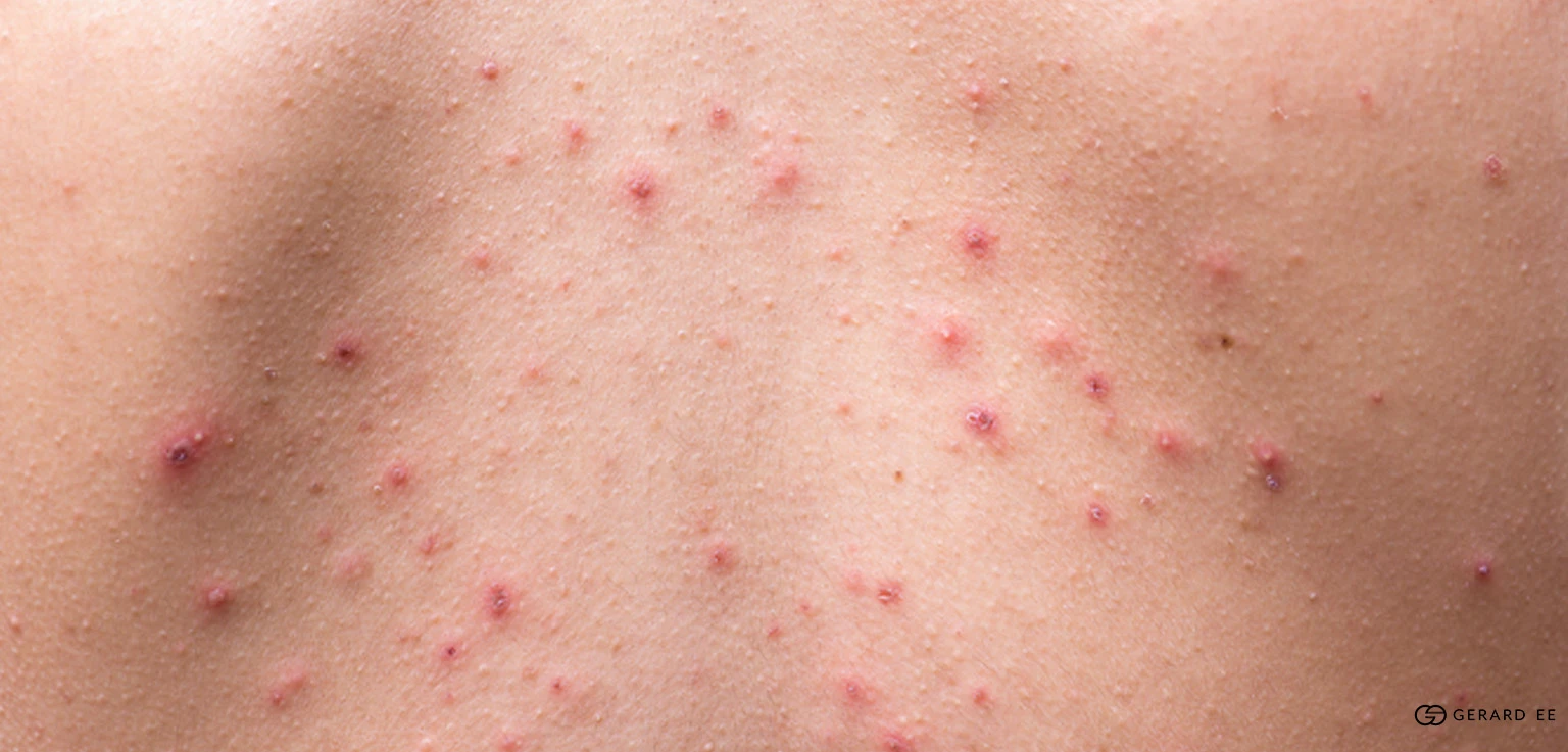 Body acne on the back and shoulders