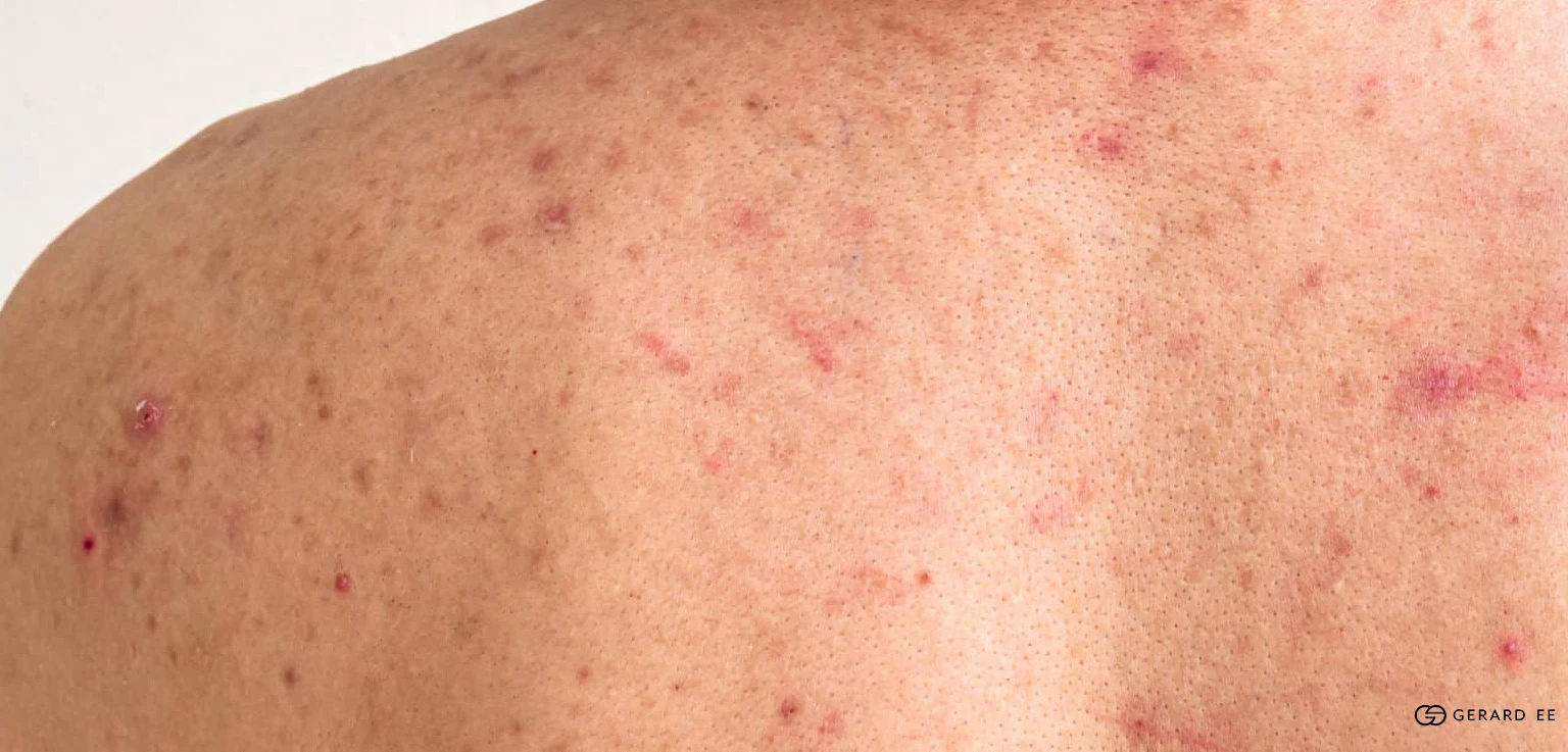 body acne singapore 2 Chest acne in Singapore