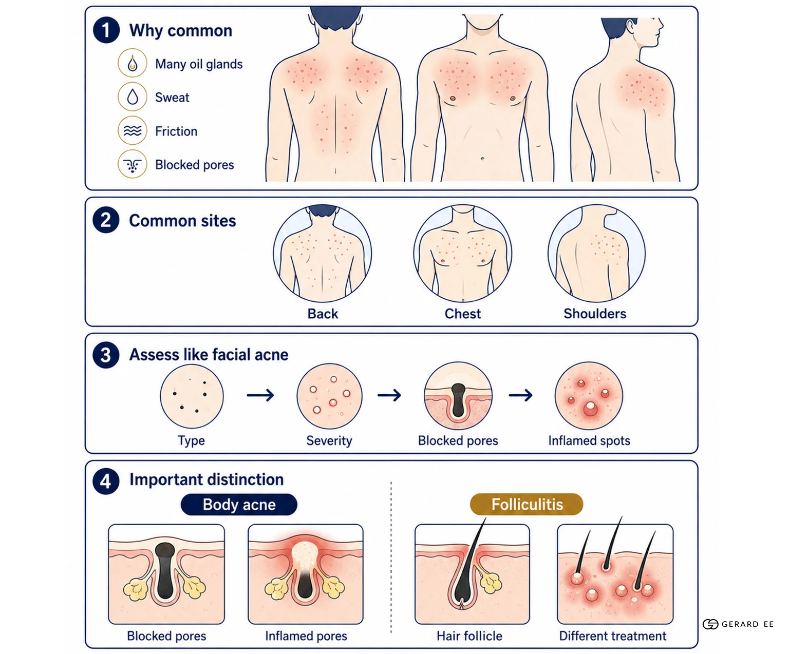 body acne diagram Diagram of where body acne appears