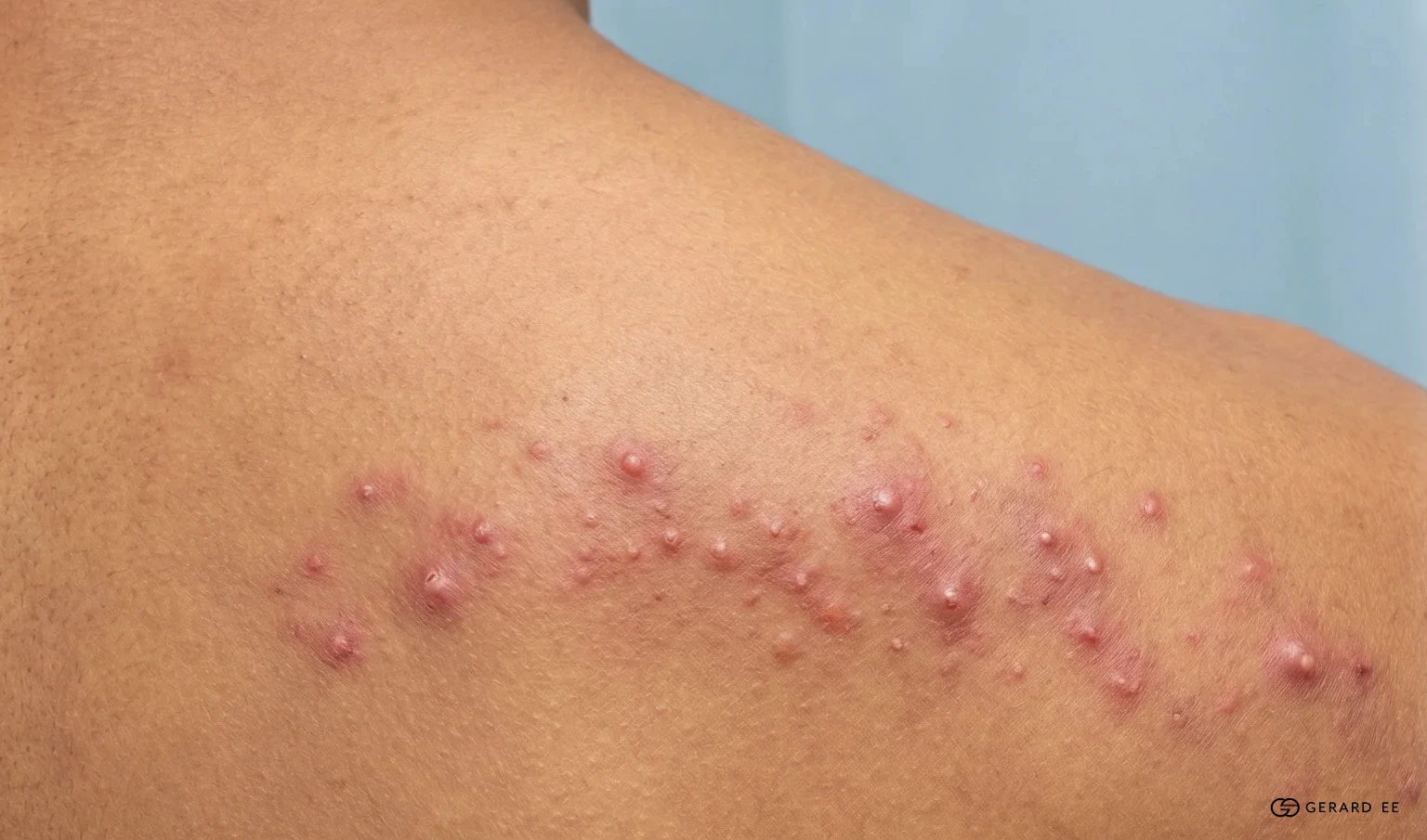 body acne Shoulder acne