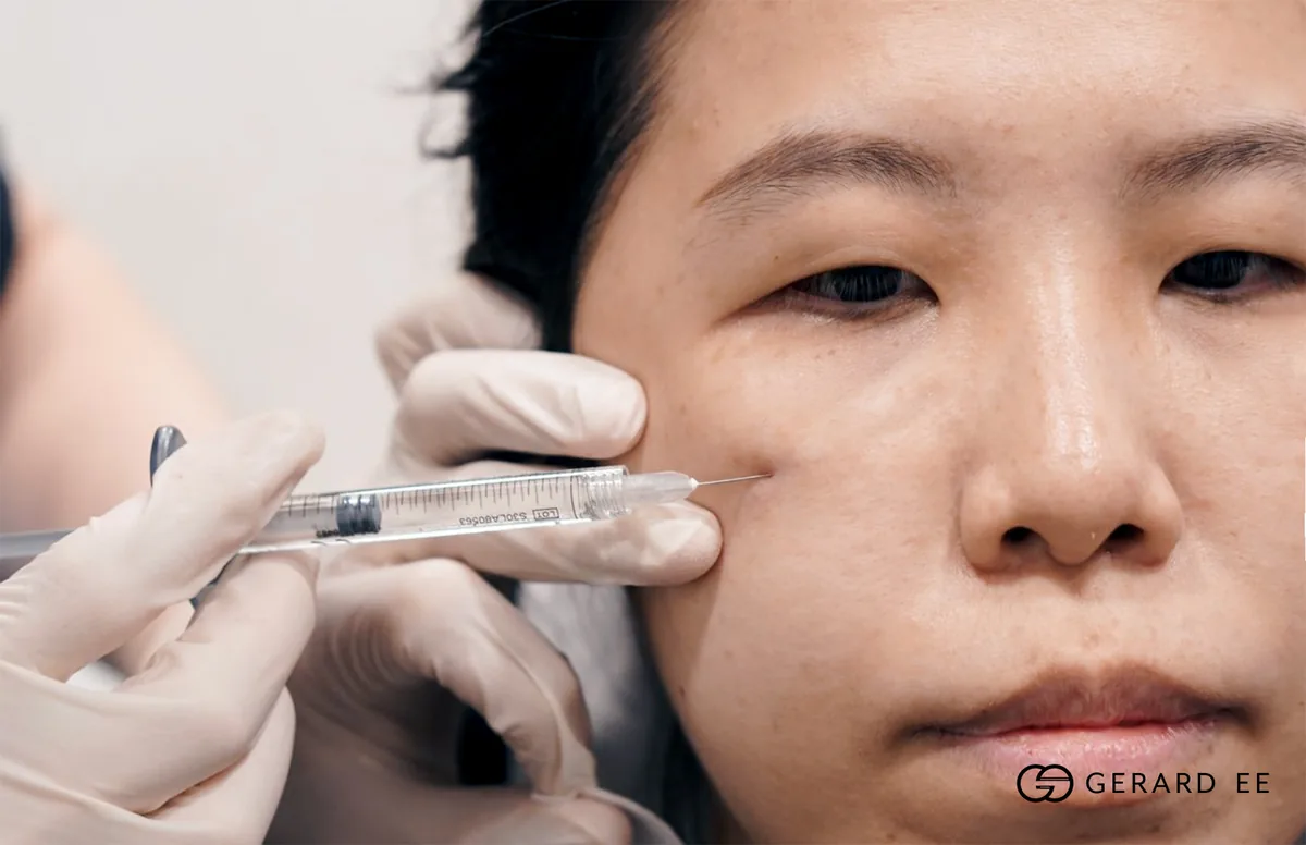 Best eye bag treatment in Singapore: dermal filler injected into the under-eye and cheek, one of the options reviewed