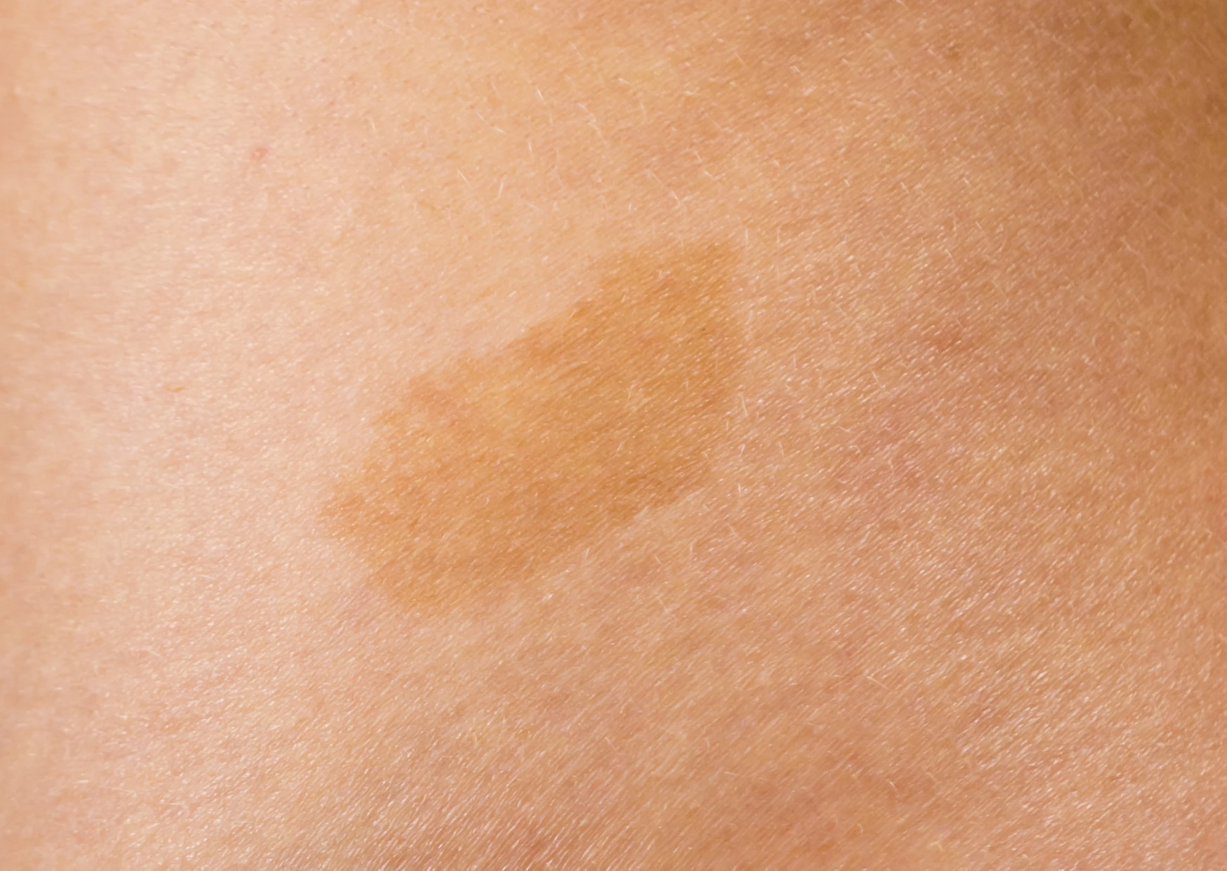 Cafe-au-lait birthmark spot on the skin