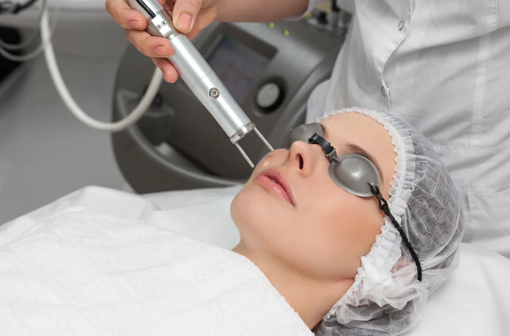 Pico laser: Birthmarks removal – Cafe Au Lait spots
