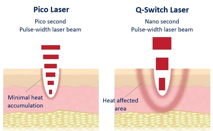Pico traditional laser: Birthmarks removal – Cafe Au Lait spots