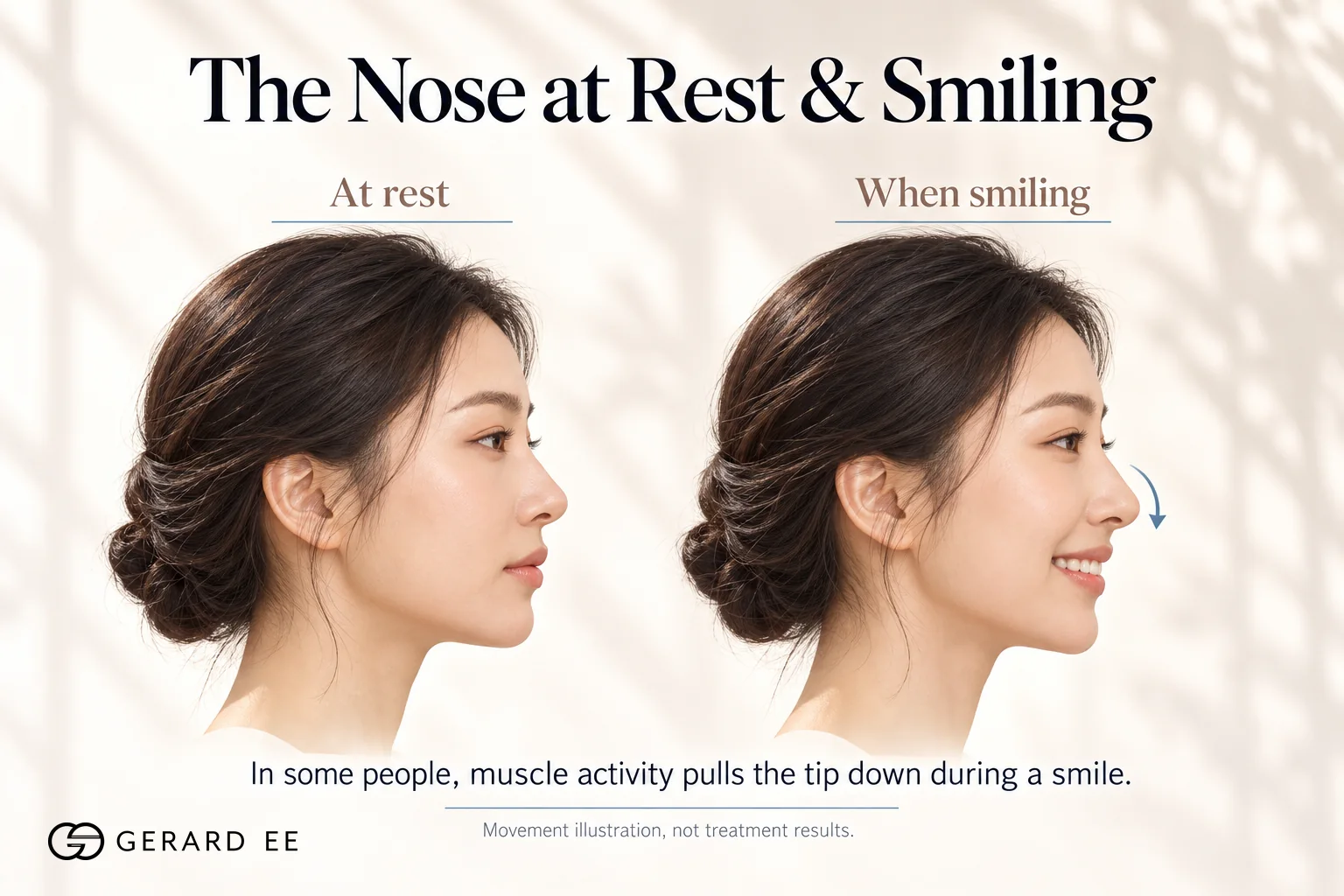 Why the nose tip drops when smiling, the nose at rest and smiling