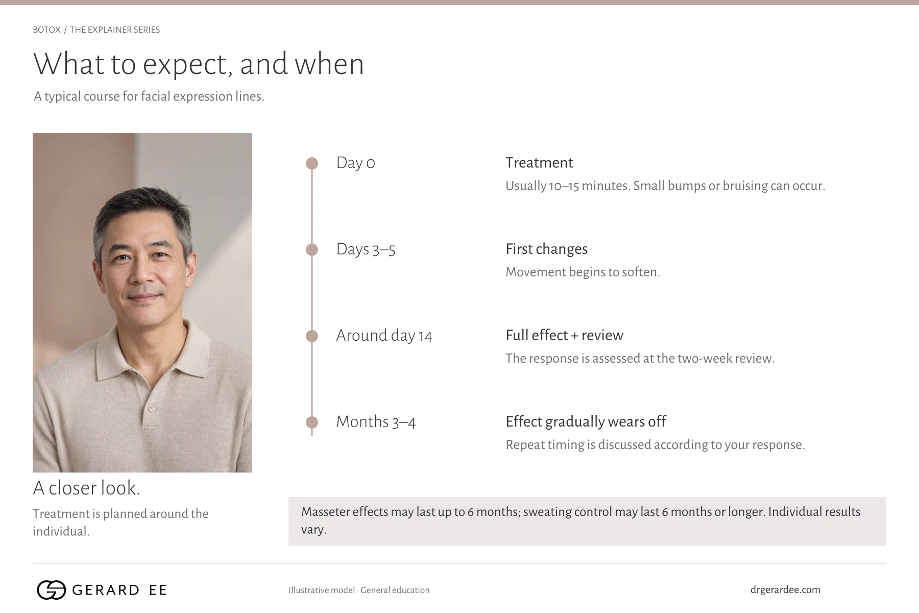 Botox timeline: treatment on day 0, first changes at days 3 to 5, full effect and review at about day 14, wearing off at months 3 to 4