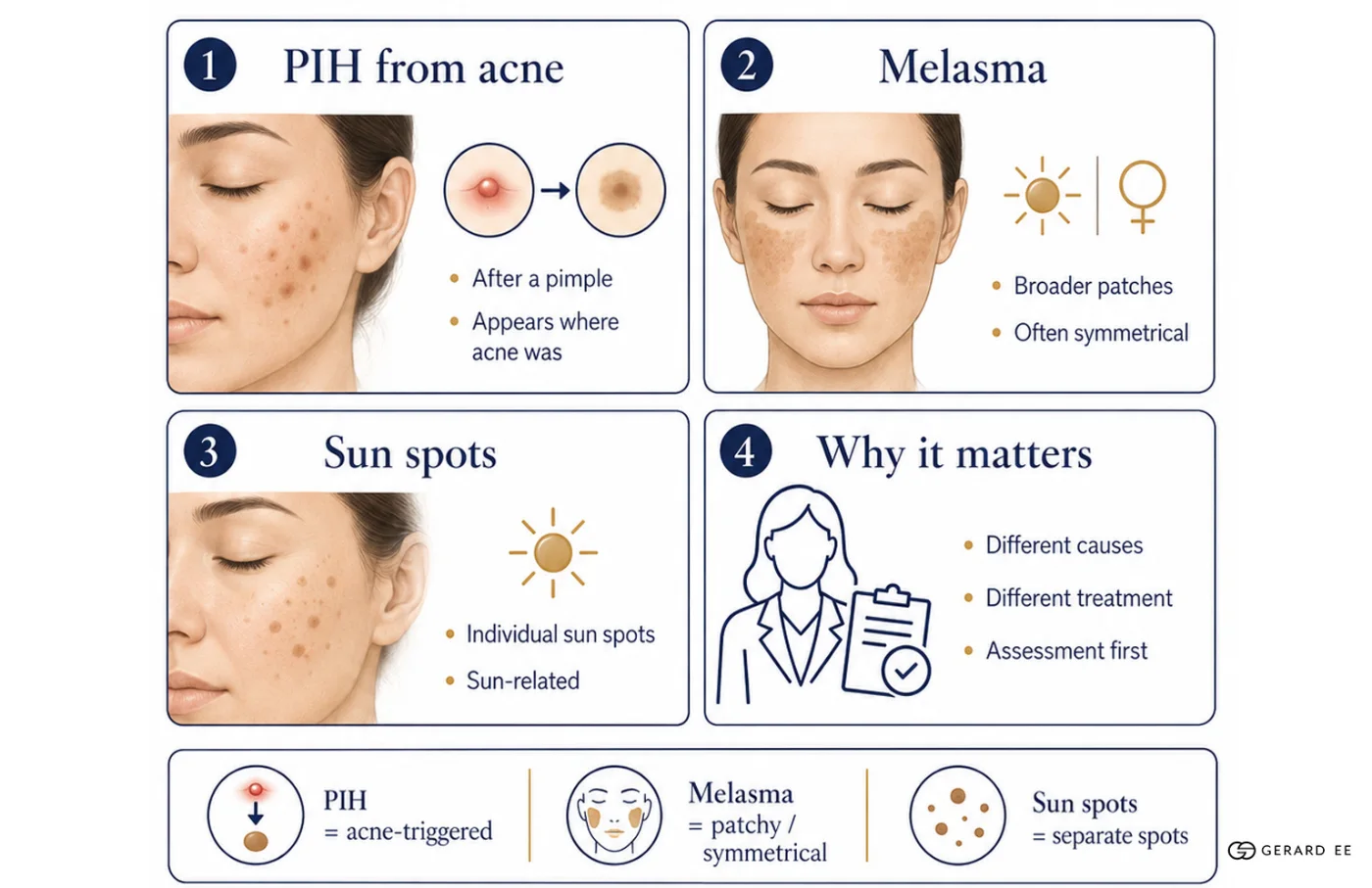 Difference between sunspots melasma: How PIH differs from other pigmentation