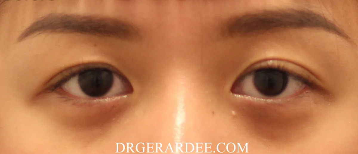 Brown pigmentation under both lower eyelids causing dark circles