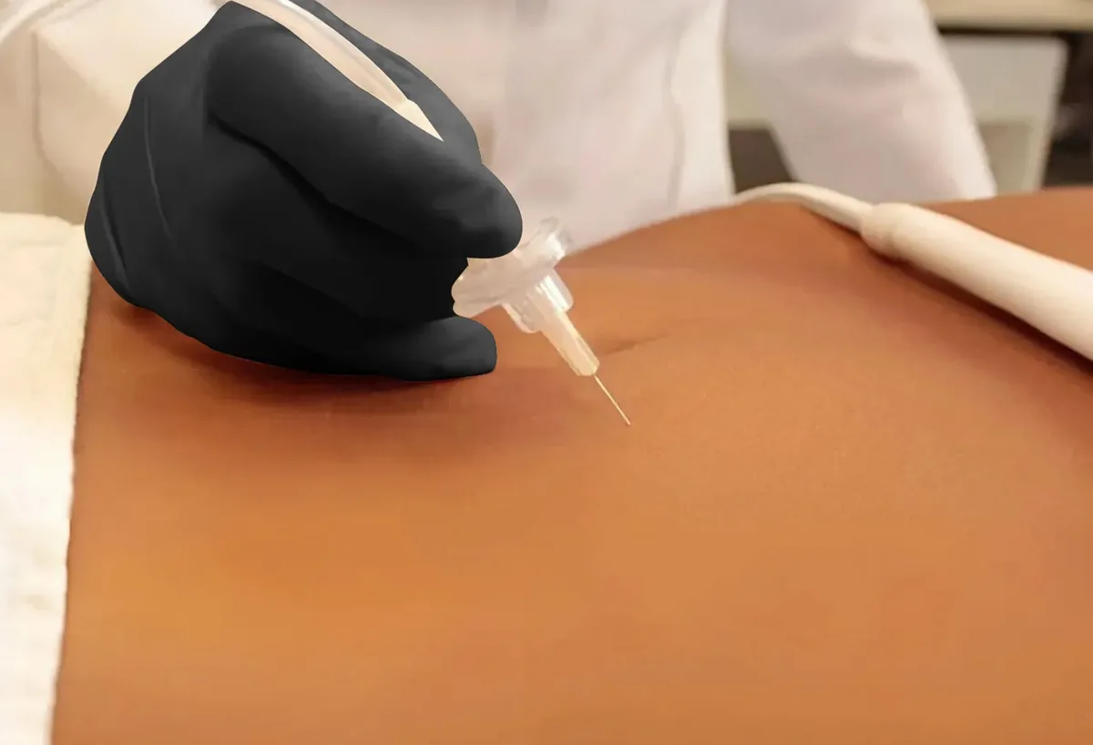 carboxytherapy under eye injection Carboxytherapy: carbon dioxide gas injected under the skin