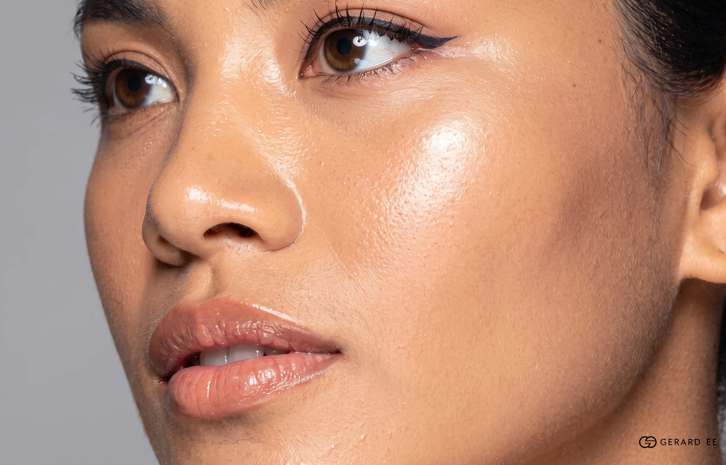 Close-up of the midface and cheekbone area treated with cheek fillers in Singapore