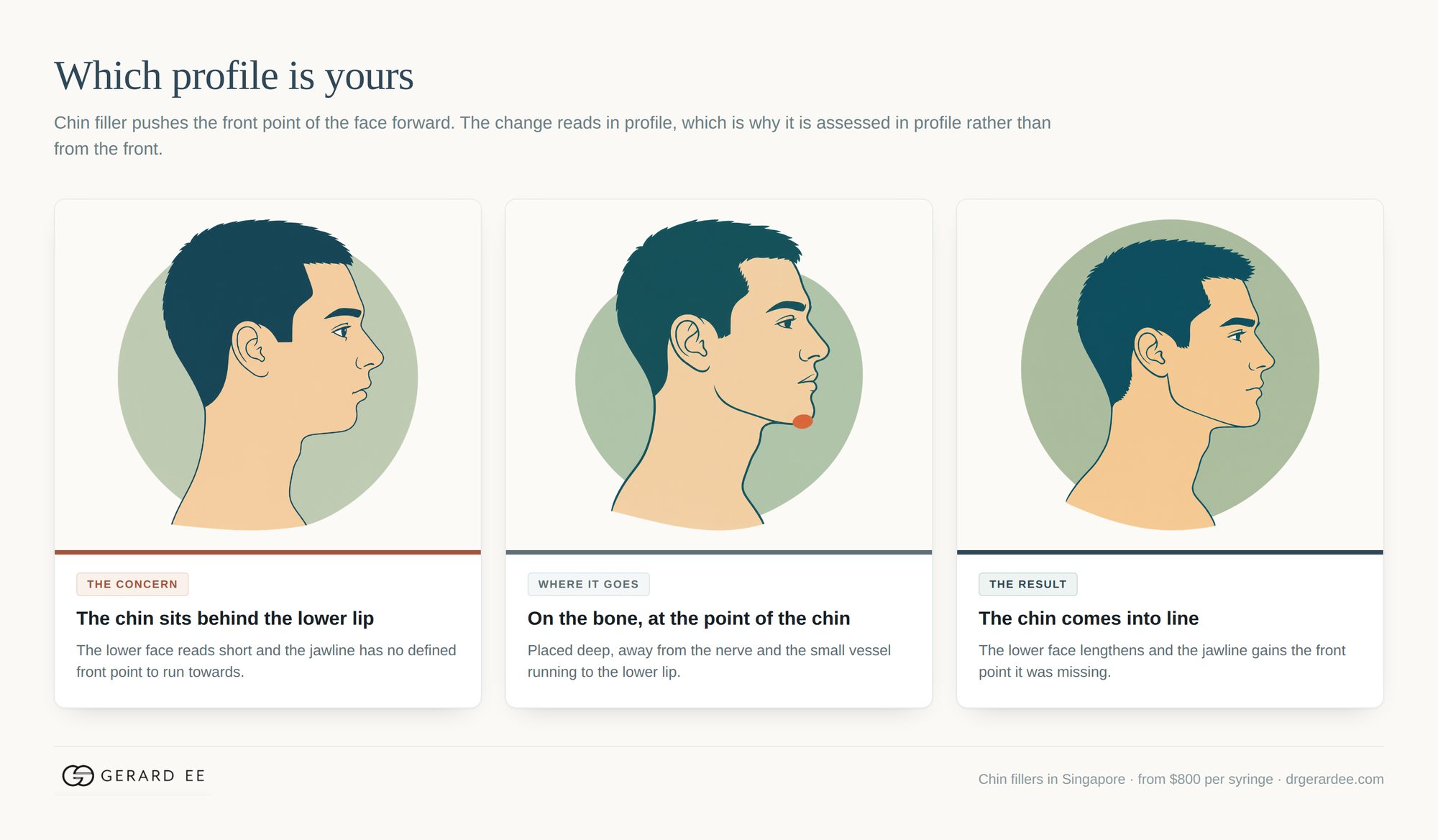 How chin filler changes the profile: weak projection, where the filler is placed, and the balanced result