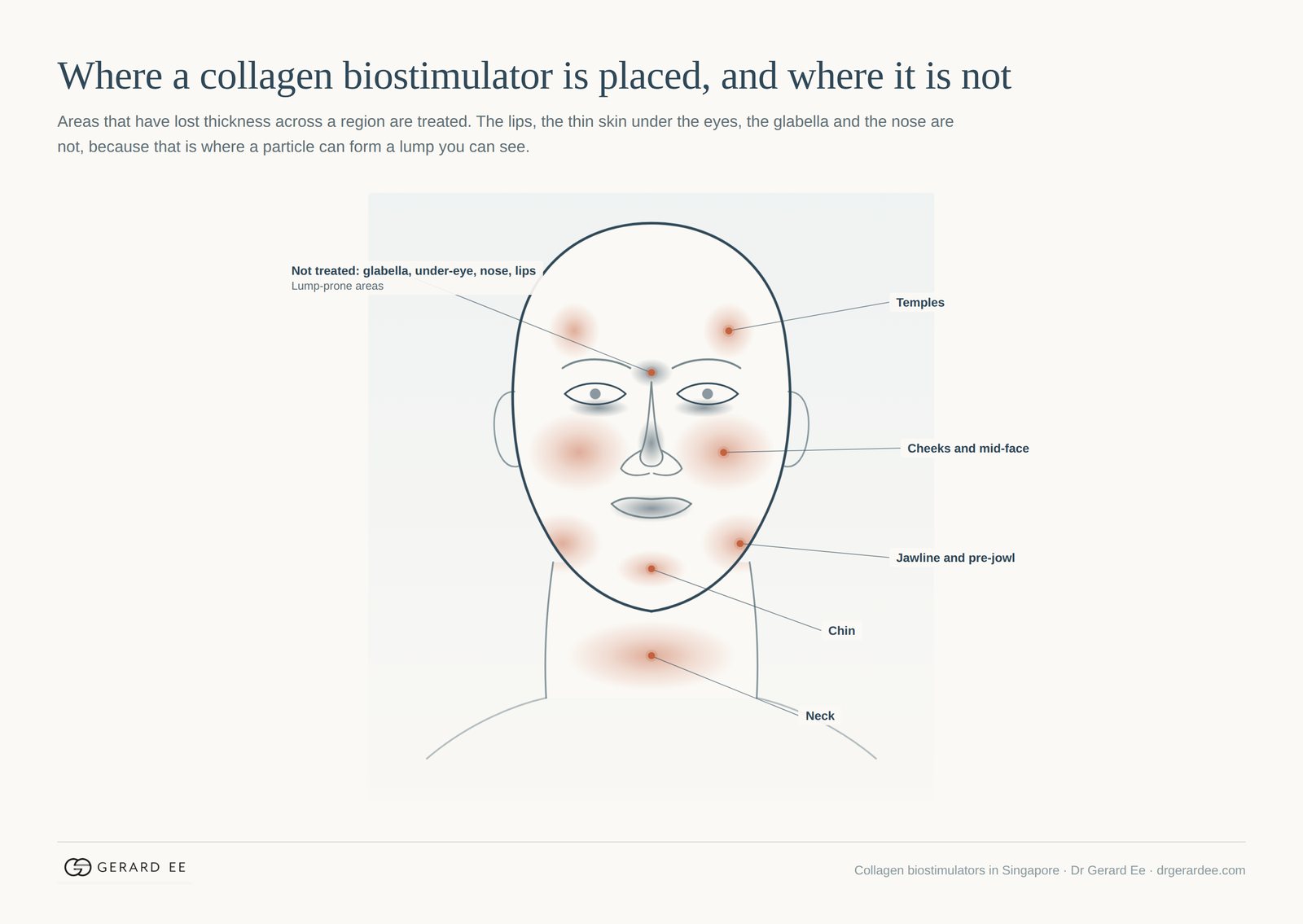 Collagen biostimulator treatment areas on the face: temples, cheeks, jawline, chin and neck treated; glabella, under-eye, nose and lips avoided